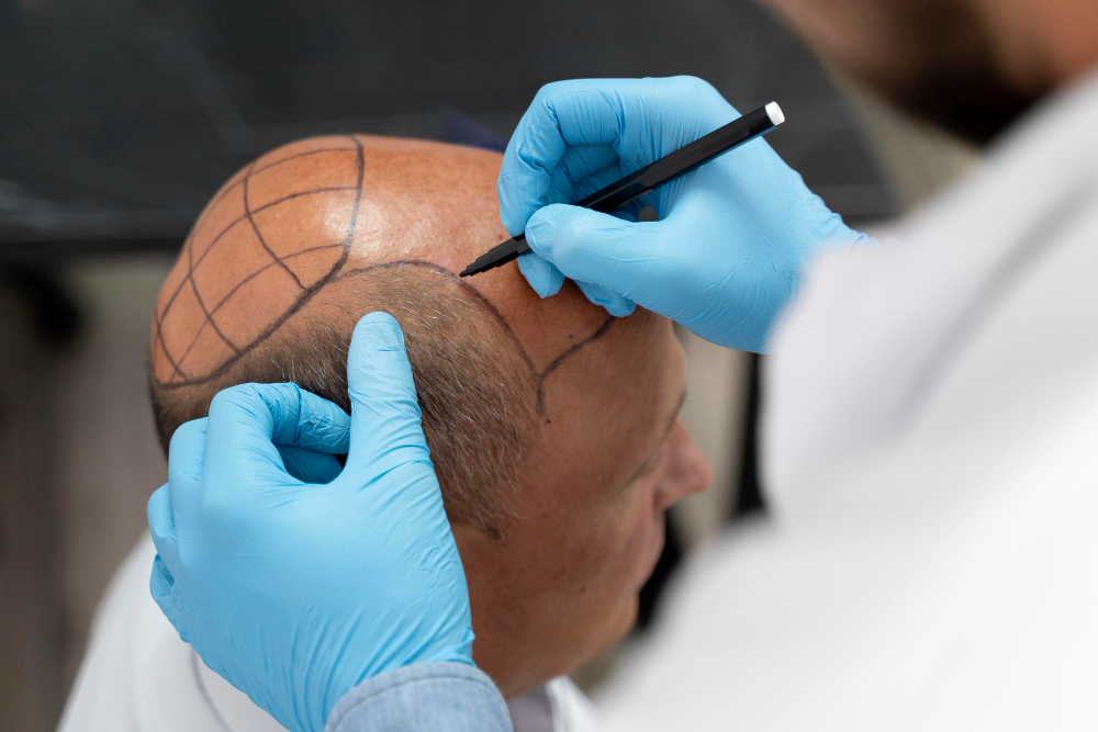 Hair Transplantation